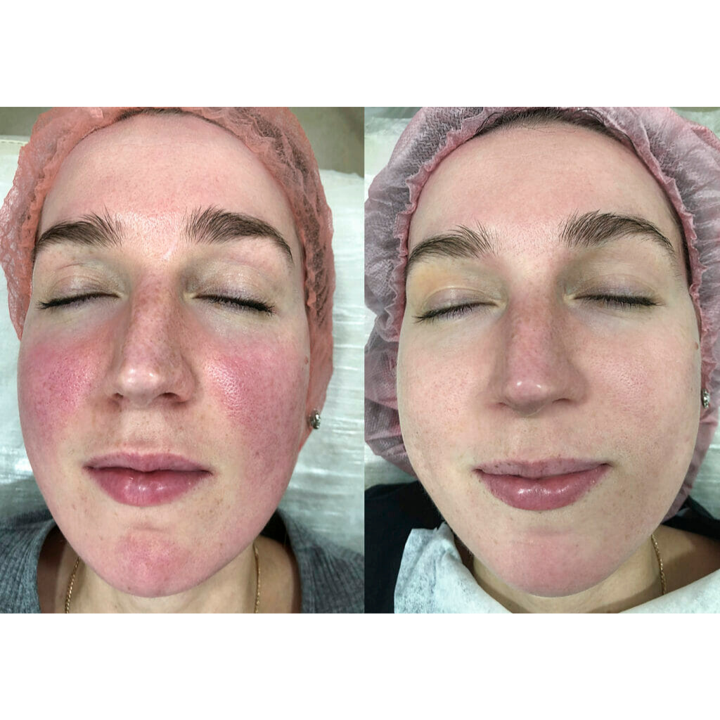 Warendorf rosacea ve yüz kızarıklığı lazer tedavisi