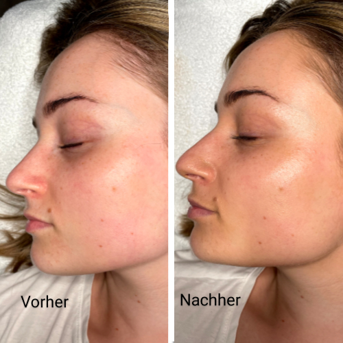 Anatomische Gewebestruktur - Radiesse® Biostimulator in Warendorf | Praxis AS Aesthetics Warendorf