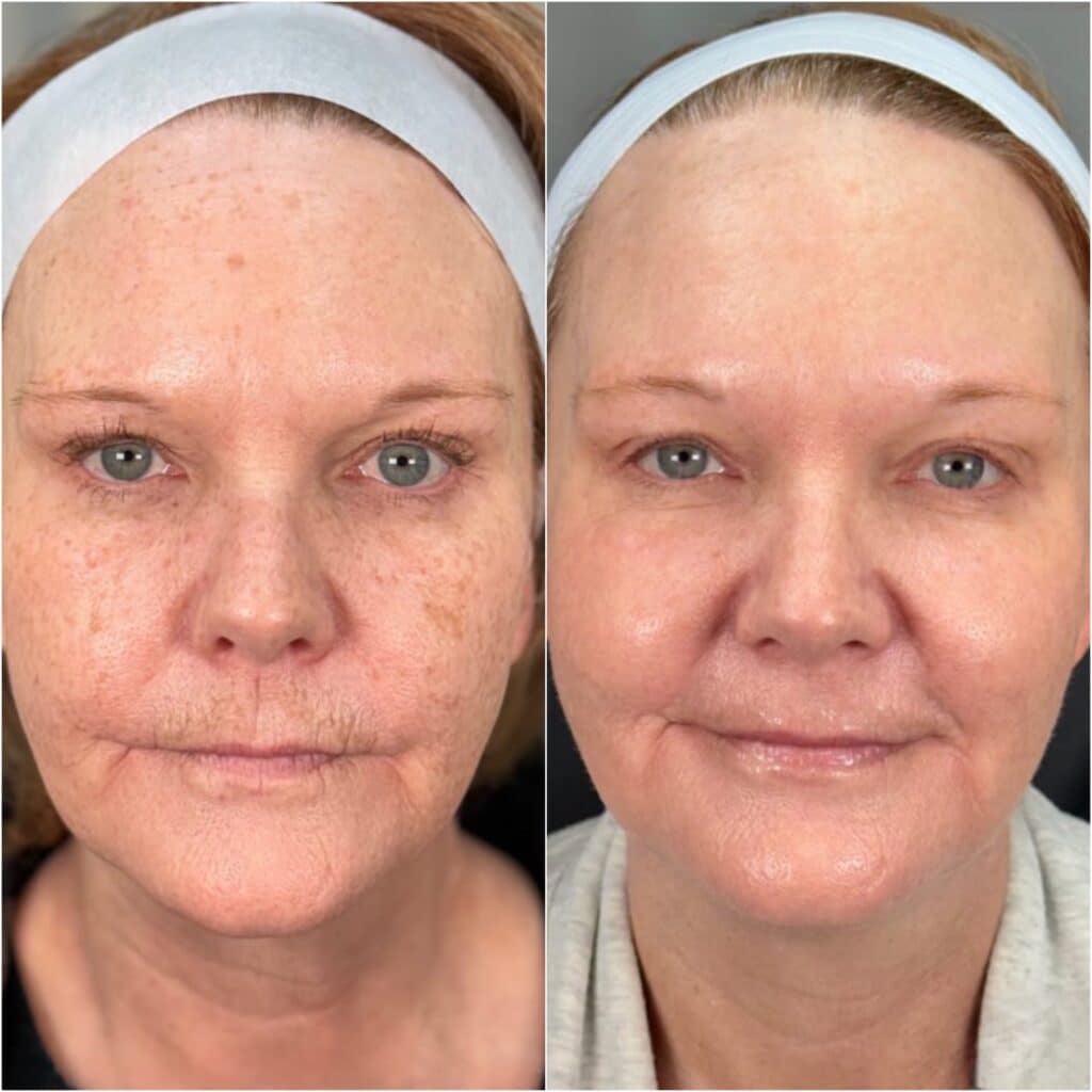 Candela GentleMax Pro Plus® | Praxis AS Medical Aesthetics Warendorf