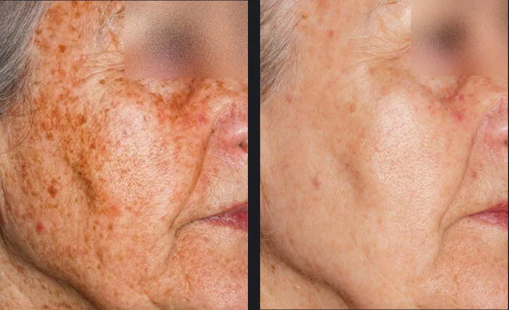 Candela Nordlys Lasertherapie klinisches Vorher-Nachher Ergebnis