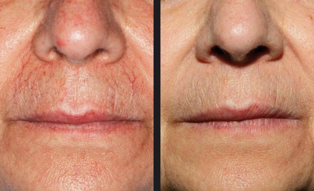 Candela Nordlys Lasertherapie klinisches Vorher-Nachher Ergebnis