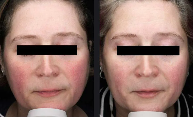 Candela Nordlys Lasertherapie klinisches Vorher-Nachher Ergebnis