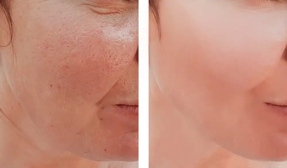 Candela Nordlys Lasertherapie klinisches Vorher-Nachher Ergebnis