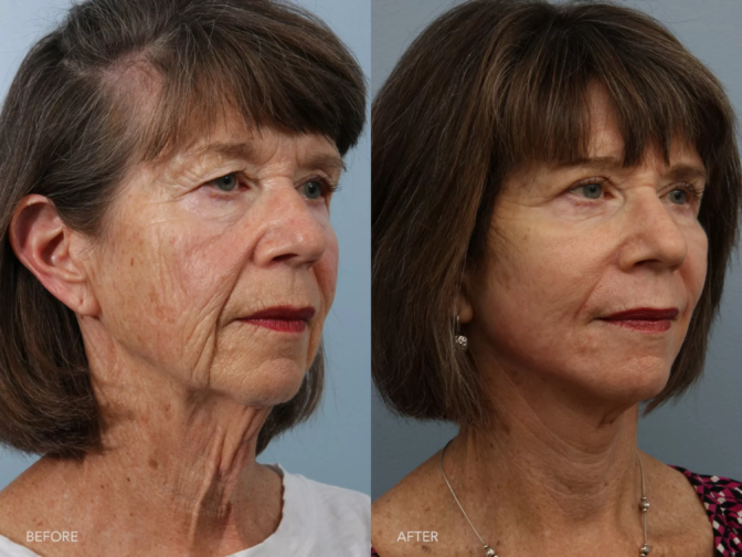 Candela Nordlys Lasertherapie klinisches Vorher-Nachher Ergebnis