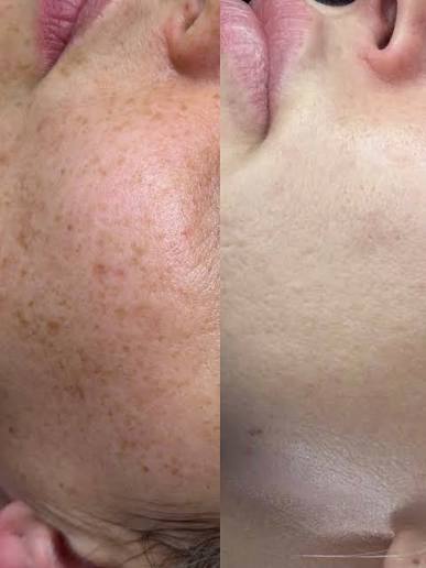 Lasertherapie bei Pigmentflecken und Melasma Warendorf