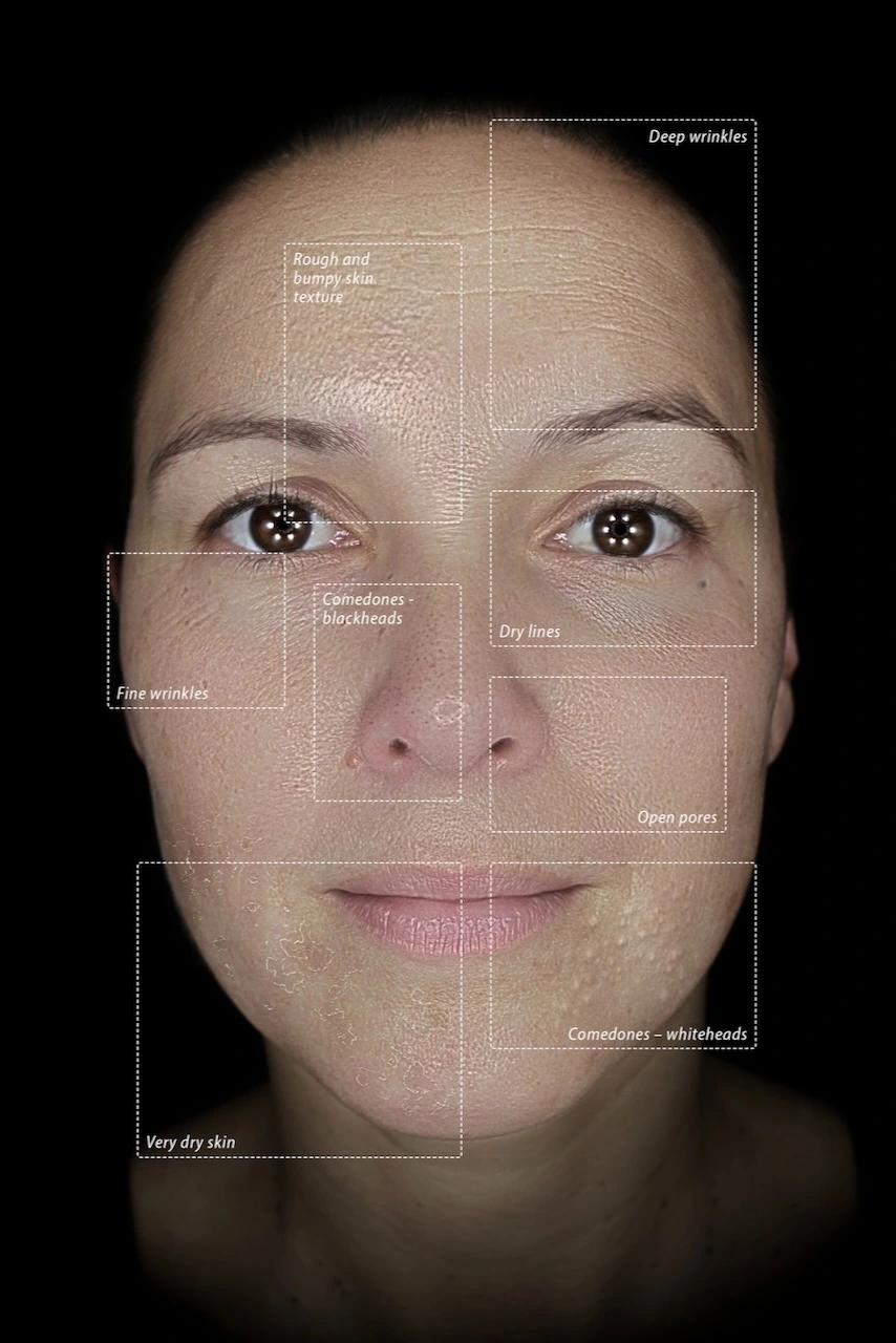 OBSERV 520x digitales Hautanalysesystem und dermale Tiefendiagnostik