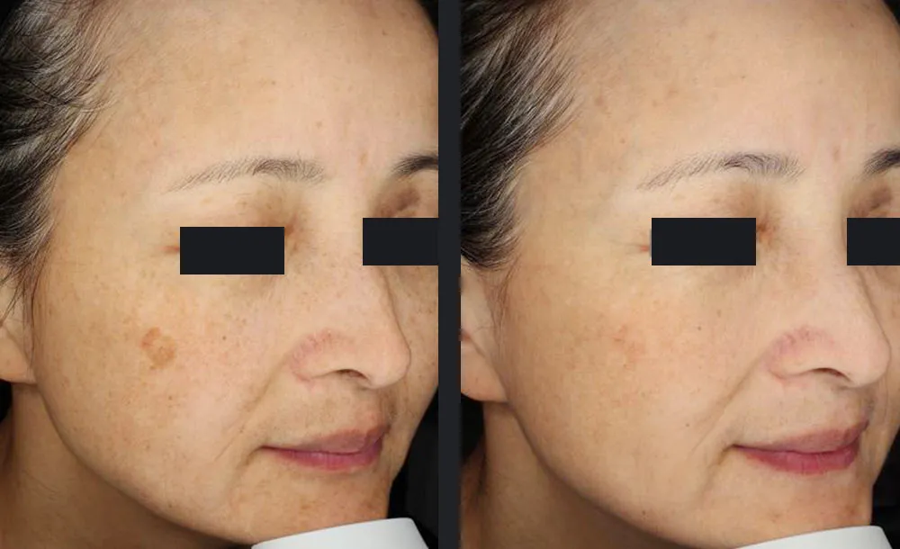 Candela PicoWay Pikosekundenlaser Pigmentbehandlung Vorher-Nachher Ergebnis