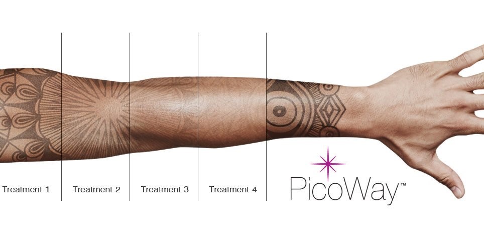 Candela PicoWay 3-wavelength photoacoustic picosecond laser system