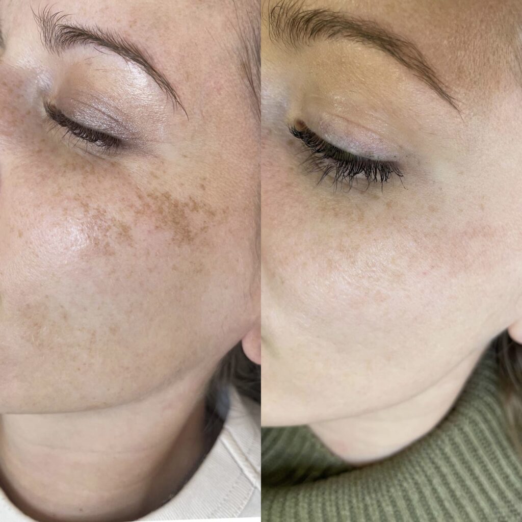 Behandlung von Pigmentflecken und Melasma zur Teint-Egalisierung