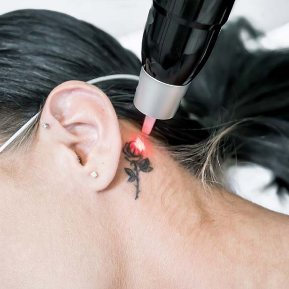 PicoWay Tattooentfernung Warendorf Münster