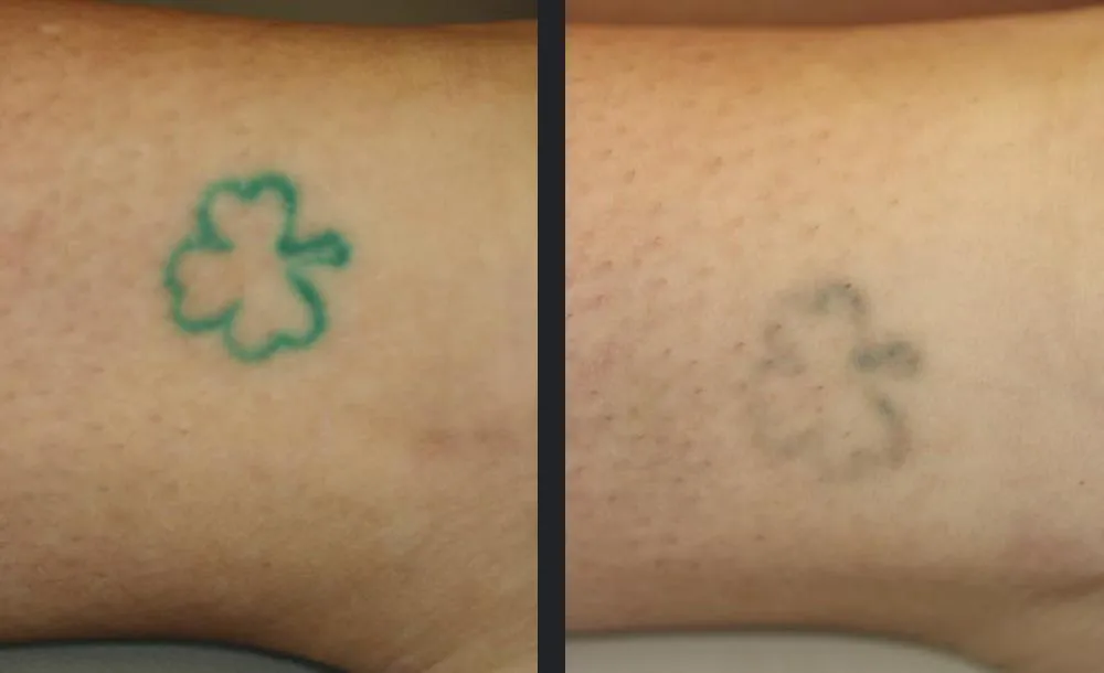 Mikro-Intervention - Permanent Laser Hair Removal in Warendorf | AS Skin & Medical Aesthetics