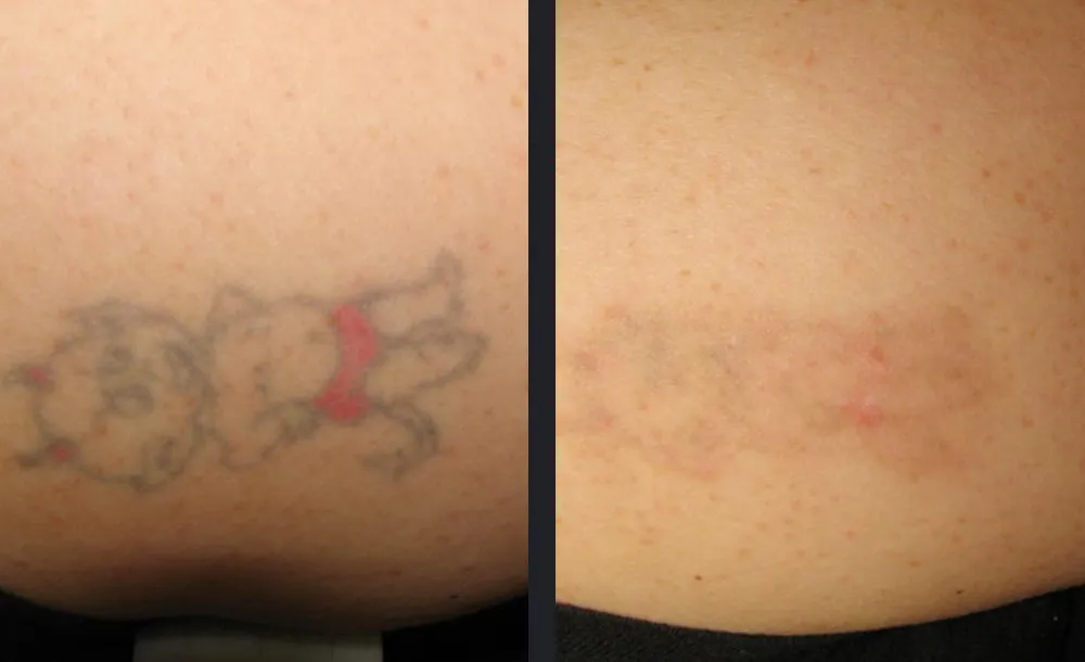 Anatomische Gewebestruktur - Radiesse® Calcium Collagen Biostimulator in Warendorf | AS Skin & Medical Aesthetics