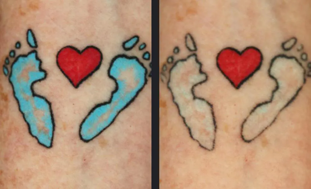 Dermale Langzeitwirkung - Permanent Laser Hair Removal in Warendorf | AS Skin & Medical Aesthetics